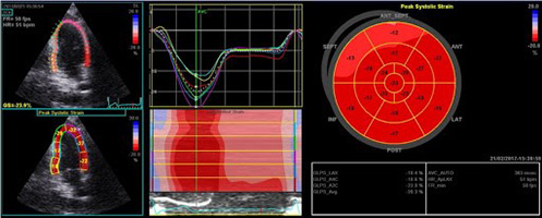 Μελέτη μυοκαρδιακής παραμόρφωσης (Speckle Tracking Imaging)
